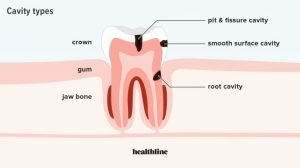 Cavities Treatment – TMJA Harmony Dental Clinic